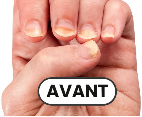 Ongles avant traitement - Mycoses visibles